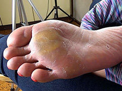【足のにおい】 イベコン・ドS水虫